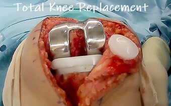 Total knee replacement surgery including patella replacement. Find out what surgery involves, the rehab process and how to make the best recovery Total knee replacement surgery including patella replacement. Find out what surgery involves, the rehab process and how to make the best recovery