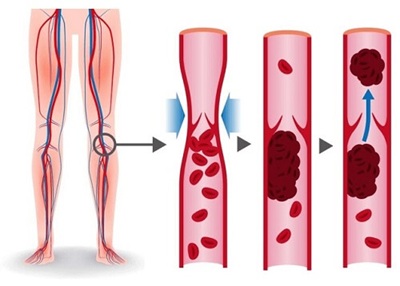 A DVT is a serious cause of pain behind the knee that requires urgent medical attention A DVT is a serious cause of pain behind the knee that requires urgent medical attention