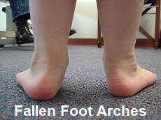 Flat feet are a common feature in those suffering from arthritis in the knee