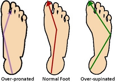 Altered foot biomechanics affects foot position which is a common cause of knee pain from running