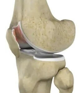 Swollen Kneecap: Chondromalacia Patella - causes, symptoms, diagnosis & treatment Swollen Kneecap: Chondromalacia Patella - causes, symptoms, diagnosis & treatment