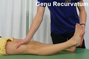 Pain behind knee hyperextension new arrivals