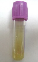 A purulent knee aspirate from a person with presumed gout