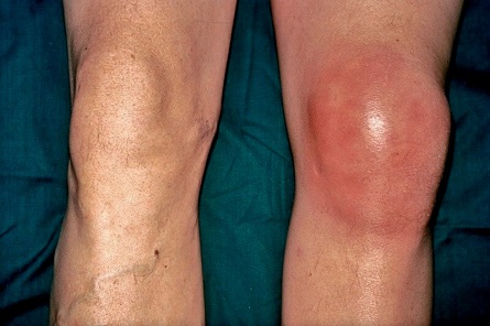 Find out about the common causes, symptoms, diagnosis and treatment of Gout Knee Find out about the common causes, symptoms, diagnosis and treatment of Gout Knee