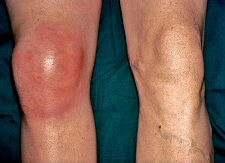 Gout Knee: Causes, Symptoms & Treatment