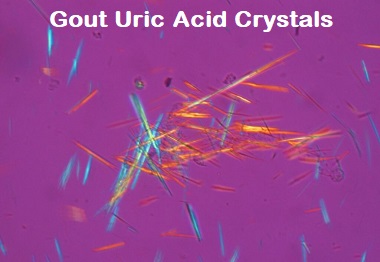 Gout In Knee Pictures: Uric acid crystals associated with gout knee