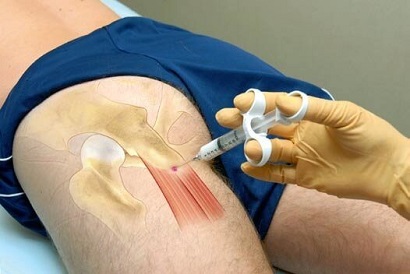 High Hamstring Tendonitis Treatment: Injections High Hamstring Tendonitis Treatment: Injections