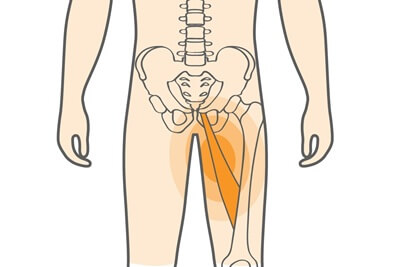 Hip and Groin Pain: A groin strain aka adductor strain is a common cause of inner thigh pain