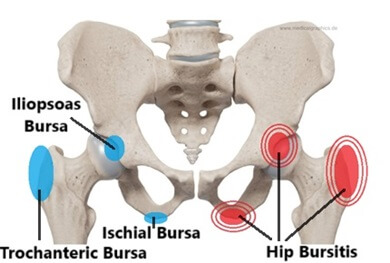 Hip Bursitis: Find out all about this different types of hip bursitis including trochanteric bursitis, iliopsoas bursitis and ischial bursitis