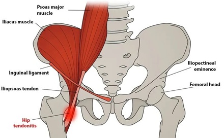 Hip Flexor Tendinopathy: Causes, symptoms and treatment of hip tendonitis Hip Flexor Tendinopathy: Causes, symptoms and treatment of hip tendonitis