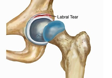 The Most Accurate Labral Tear Hip Test: Explained - fs8sobl