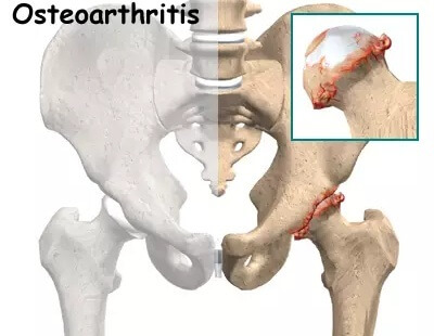 Pain in Outer Hip: Osteoarthritis of the Hip Pain in Outer Hip: Osteoarthritis of the Hip