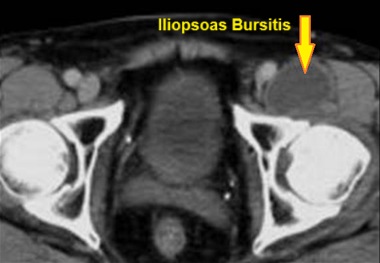 Iliopsoas Bursitis Diagnosis. Scan showing inflamed iliopsoas bursa