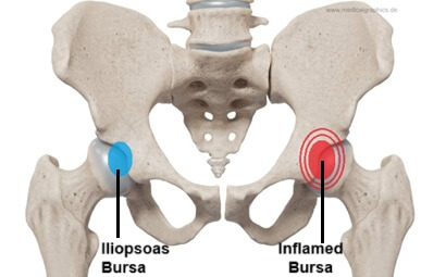 Inflammation of the Iliopsoas bursa results in iliopsoas bursitis, aka iliopectineal bursitis, causing front hip pain