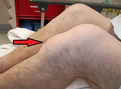 Infrapatellar Bursitis Symptoms: Swelling of the infrapatellar bursa Infrapatellar Bursitis Symptoms: Swelling of the infrapatellar bursa