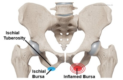 Ischial Bursitis: Inflammation of the ischial bursa located between the ischial tuberosity and gluteus maximus tendon
