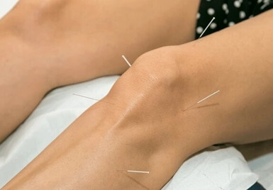 Acupuncture is increasingly popular alternative medicine for arthritis Acupuncture is increasingly popular alternative medicine for arthritis