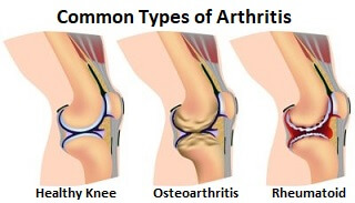 Burning Knee Pain Causes Symptoms