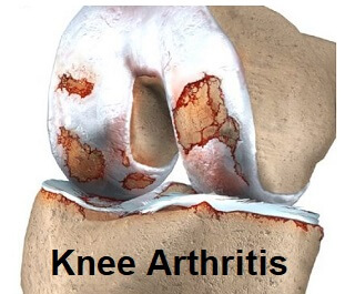 knee arthritis exercises