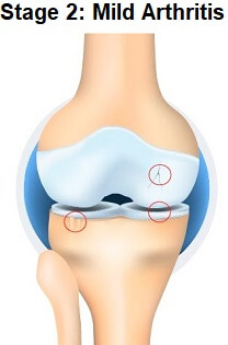 Stage 2 Knee Arthritis
