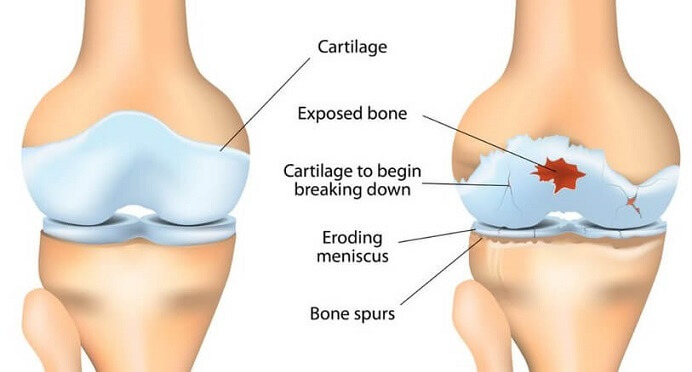 Bone Spurs In Knee Causes Symptoms Treatment Of Knee Osteophytosis