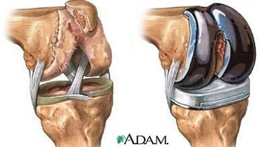 Bone Spur Knee Surgery: Total Knee Replacement Bone Spur Knee Surgery: Total Knee Replacement