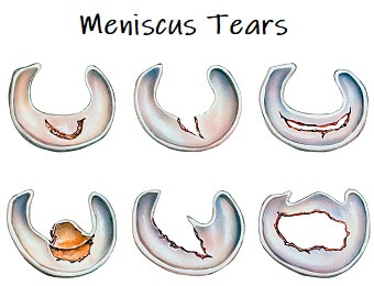 Different types of knee meniscus injuries. Different types of knee meniscus injuries.
