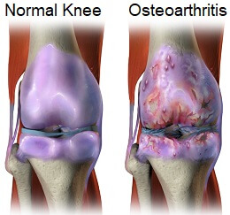 Medial Knee Pain Causes Treatment