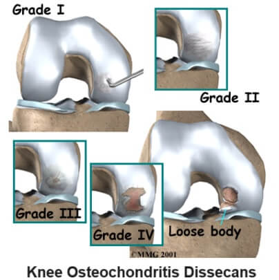 Knee Osteochondritis Dissecans: Common causes, symptoms, diagnosis & treatment