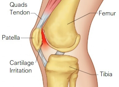 Pain from Running: Causes & Treatment - Knee