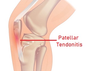 Knee Pain Kneeling Causes Treatment