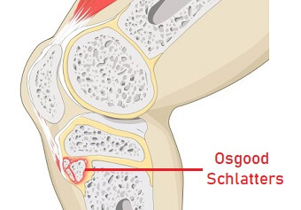 Knee Pain Kneeling Causes Treatment Knee Pain Explained