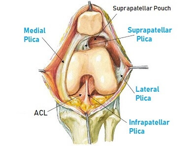 Lump On Side Of Knee: Plica Syndrome. Causes, symptoms, diagnosis & treatment