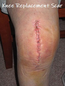 Total knee replacement scar with staples