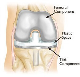 Knee Replacement Exercises: Pre & Post Op - Knee Pain Explained