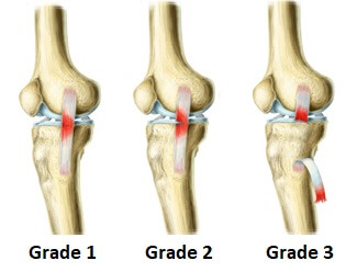 Ligament (MCL) Injury - Pro-Tec Athletics