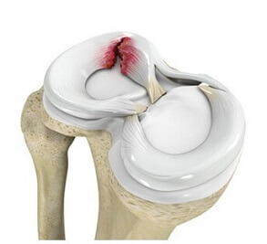 Meniscus tears in the knee cartilage can cause anterior knee pain Meniscus tears in the knee cartilage can cause anterior knee pain