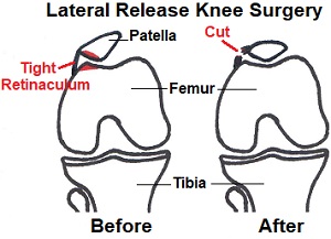 Lateral Release Knee Surgery &amp; Recovery - Knee Pain Explained