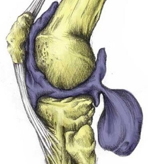 Lump Below Knee: Bakers Cyst. Causes, symptoms, diagnosis and treatment of popliteal bursitis swelling below the knee Lump Below Knee: Bakers Cyst. Causes, symptoms, diagnosis and treatment of popliteal bursitis swelling below the knee