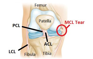 MCL Tear: Medial Collateral Ligament knee injuries - Causes, Symptoms, Diagnosis & Treatment