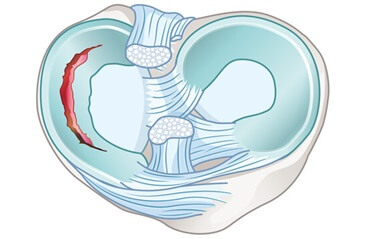 A cartilage tear is a common cause of medial knee pain.