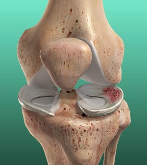 Large Inside Of Knee