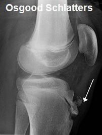 Osgood schlatters Disease is on of the most common causes of knee pain in teenager