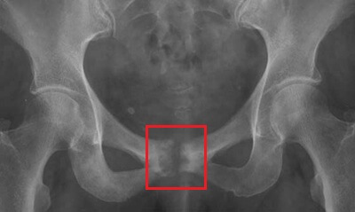 Osteitis Pubis Xray showing irritation and inflammation at the pubic symphysis Osteitis Pubis Xray showing irritation and inflammation at the pubic symphysis