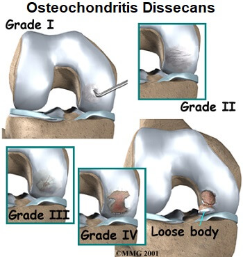 osteochondritis dissecans stages