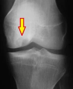 X-ray showing Osteochondritis Dissecans of the knee
