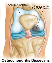 Osteochondritis Dissecans is one of the less common causes of anterior knee pain