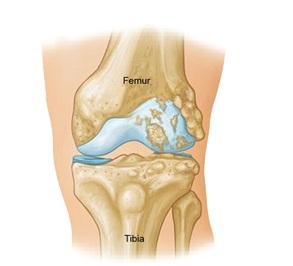 Lateral Knee Pain Causes Treatment Knee Pain Explained