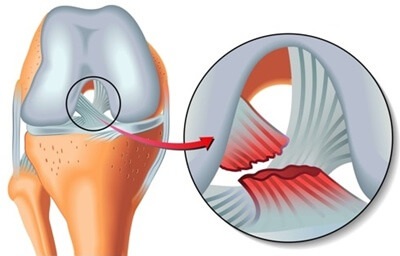 Pain Behind Knee Causes: ligament tears can cause posterior knee pain and swelling, Find out more about the causes, symptoms, diagnosis and treatment Pain Behind Knee Causes: ligament tears can cause posterior knee pain and swelling, Find out more about the causes, symptoms, diagnosis and treatment