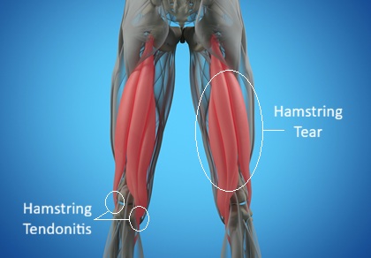 Pain Behind Knee: Hamstring Injuries. Hamstring tendonitis causes pain at the back of the knee, hamstring tears cause pain in the back of the thigh Pain Behind Knee: Hamstring Injuries. Hamstring tendonitis causes pain at the back of the knee, hamstring tears cause pain in the back of the thigh